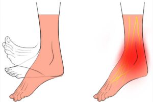 افتادگی مچ پا سکته مغزی